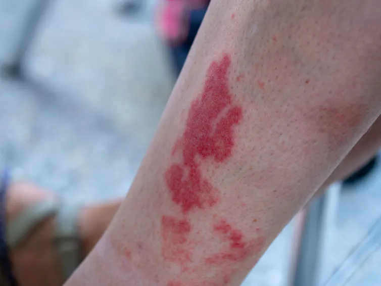 A person with purpura.