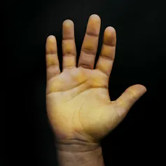 The palm of a hand that has turned orange from excess beta-carotene.