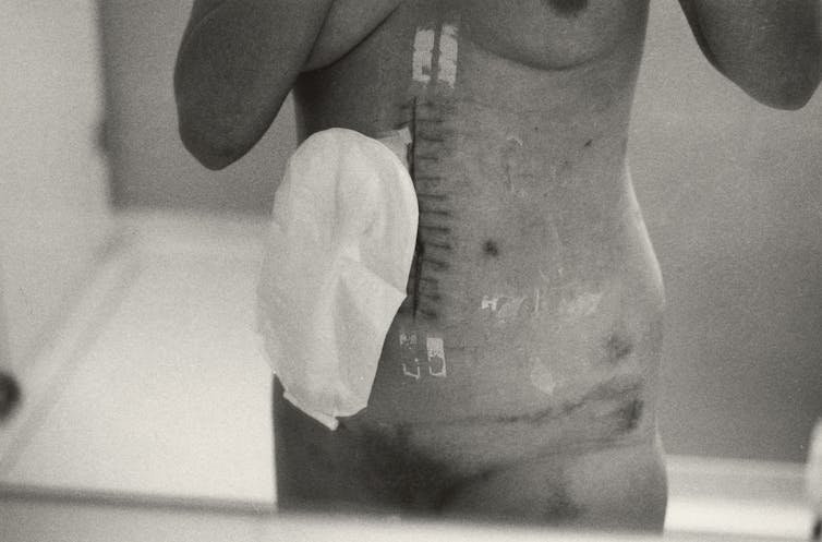 A naked torso with a colostomy bag.
