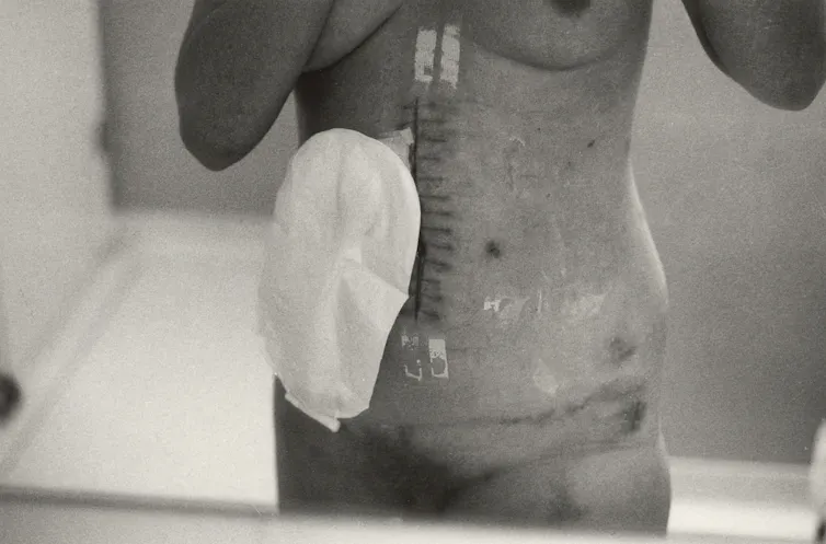 A naked torso with a colostomy bag.