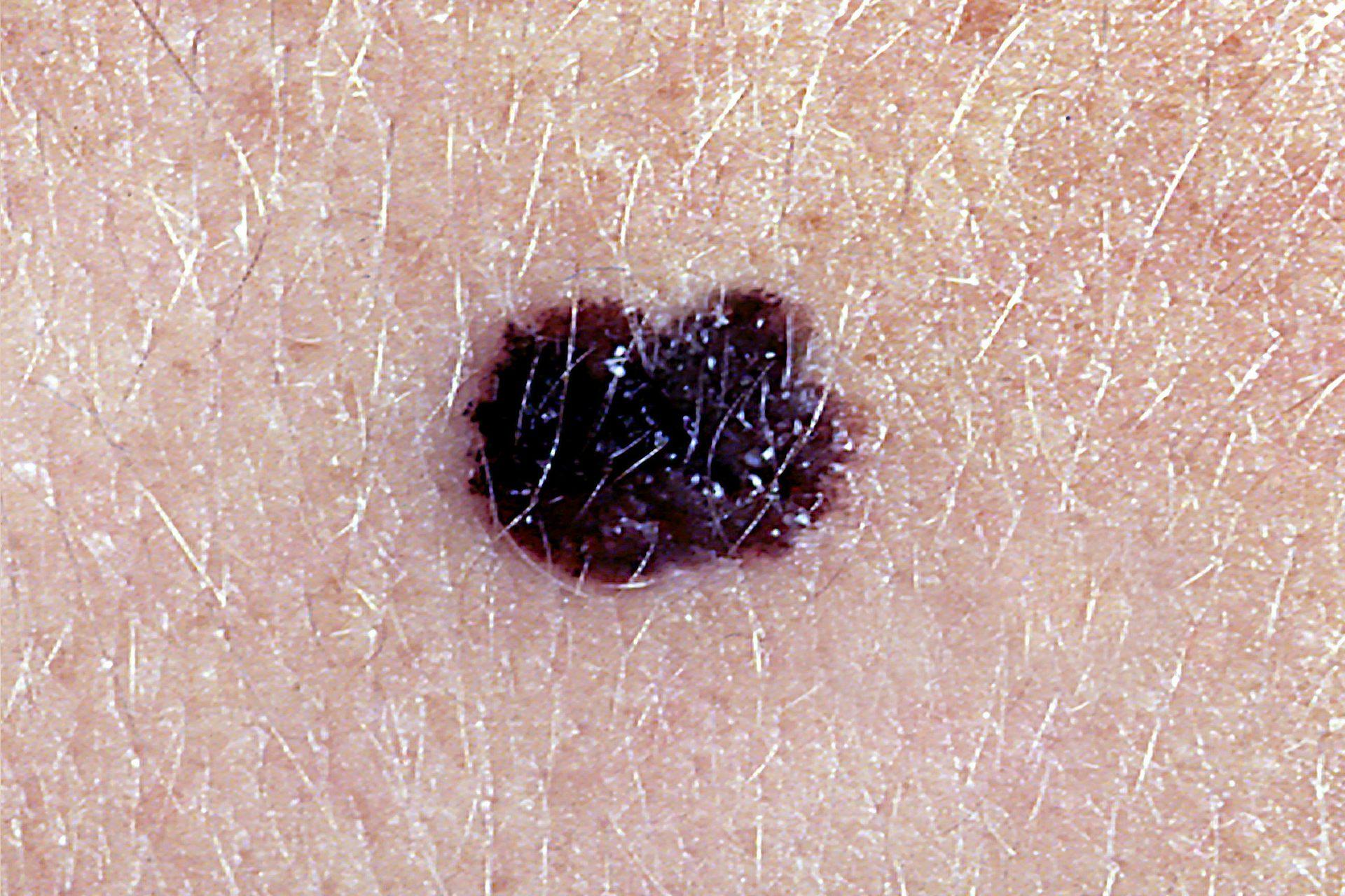 A malignant melanoma on a patch of skin.