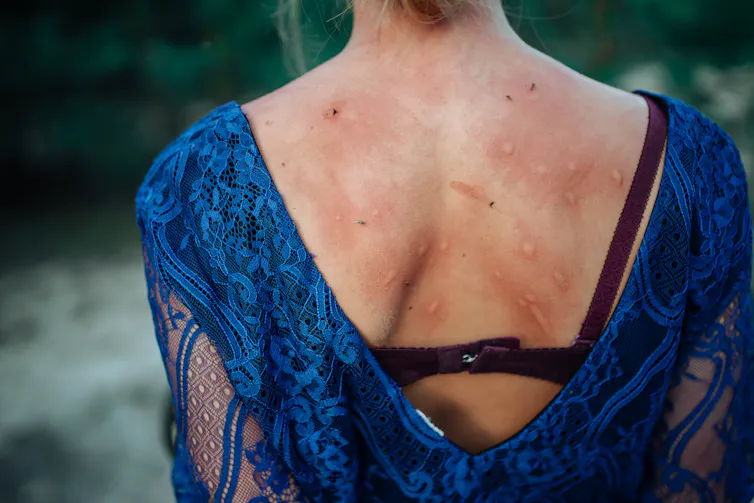 Person with several mosquito bites on their back, some flies yet clinging to their skin