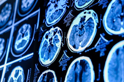 Around 3% of us will develop a brain aneurysm in our lives. So what is it and how do you treat it?