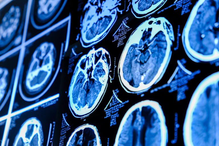 MRI images of a brain.