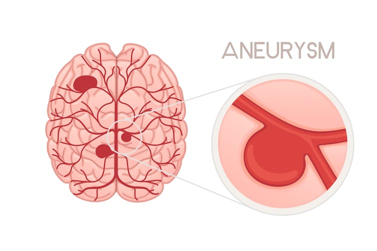 An illustration showing a brain aneurysm.
