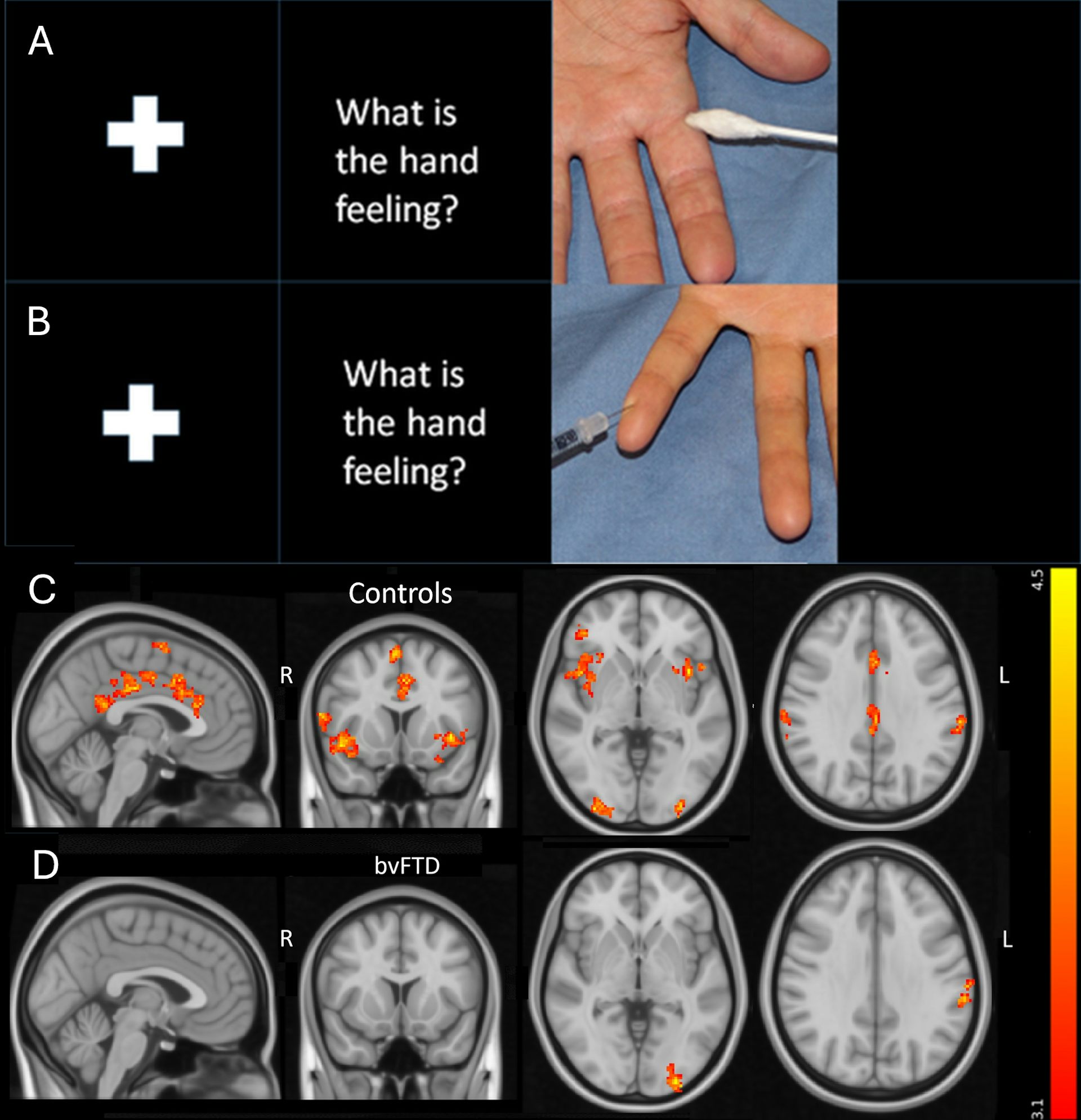Images that compare brain activity in healthy people and people with frontotemporal dementia when viewing an image of a person experiencing pain.