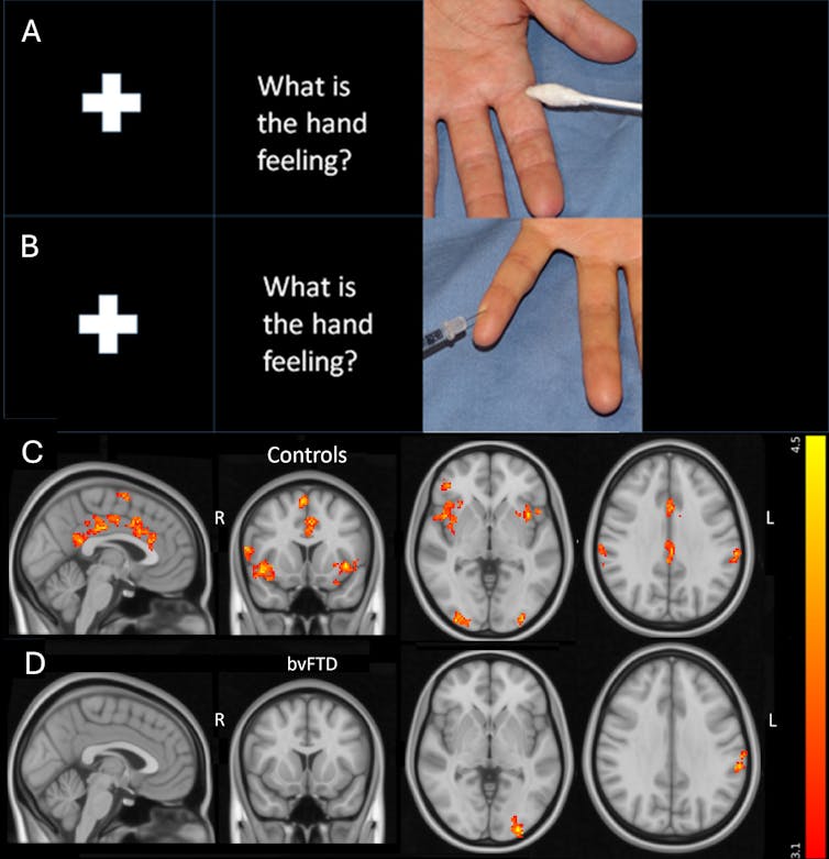 Images that compare brain activity in healthy people and people with frontotemporal dementia when viewing an image of a person experiencing pain.