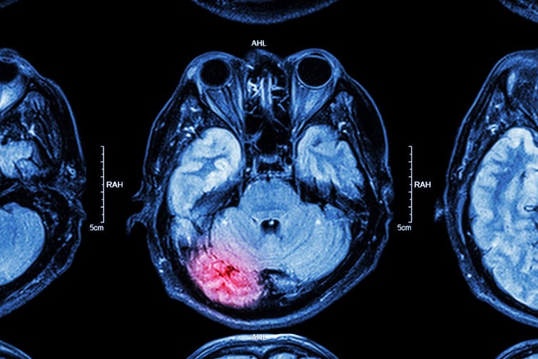 MRI scan of brain with one area highlighted in red