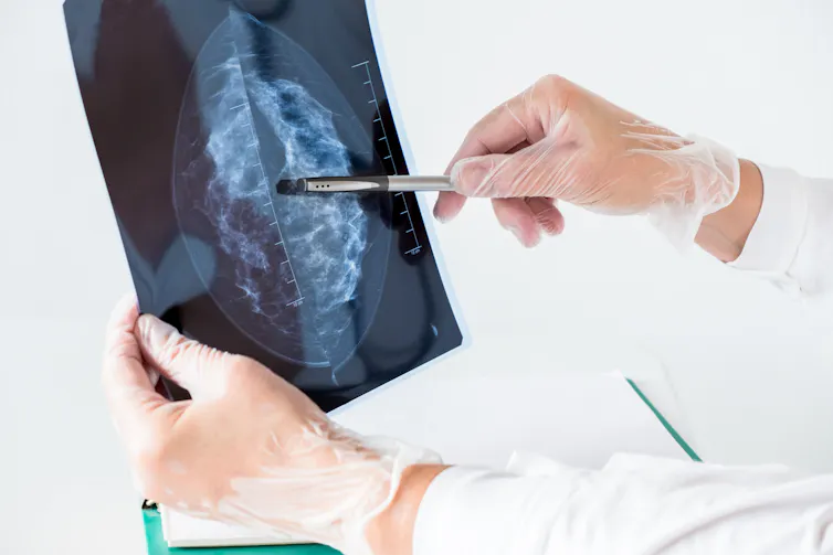 Hands in surgical gloves point a pen at a breast x-ray image.