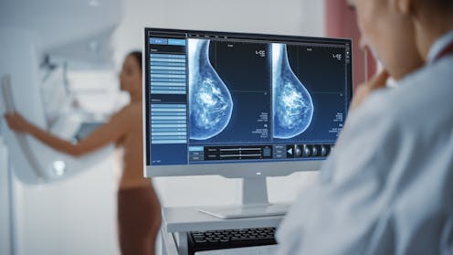 Having dense breasts is linked to cancer. But advice about breast density can depend on where you live