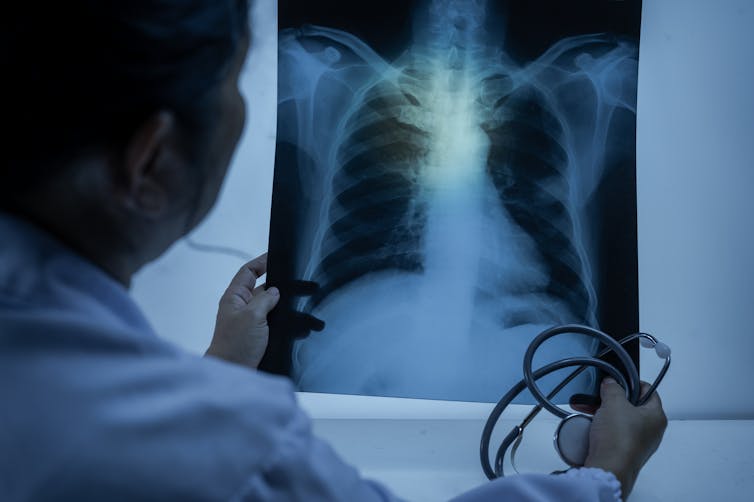A doctor inspects an x-ray of a lung.