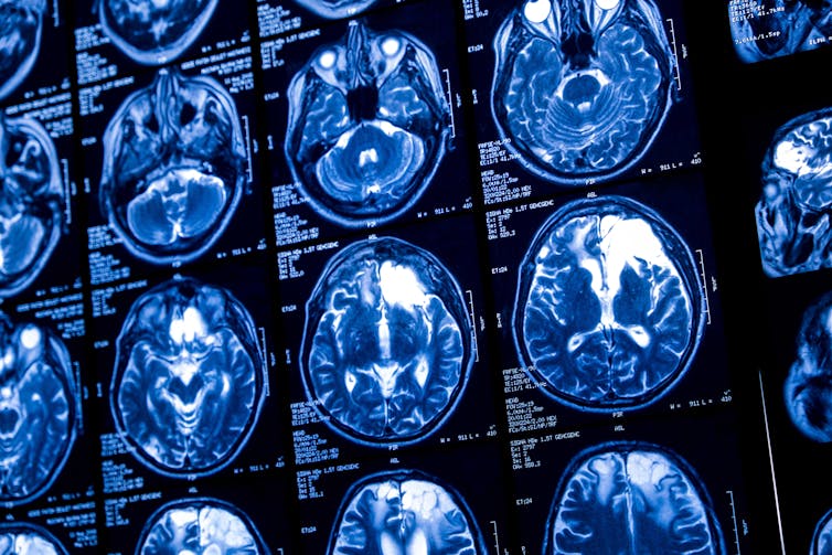 A grid of brain scans on a computer screen.
