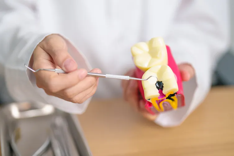 A dentist pointing to tooth decay on a plastic model of teeth.