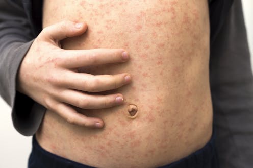 Texas records first US measles death in 10 years – a medical epidemiologist explains how to protect yourself and your community from this deadly, preventable disease