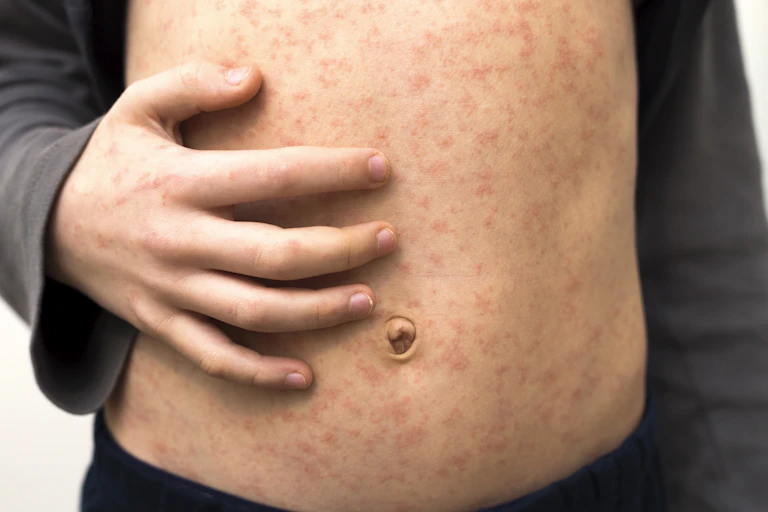 Torso of a white child with red rash spots from measles