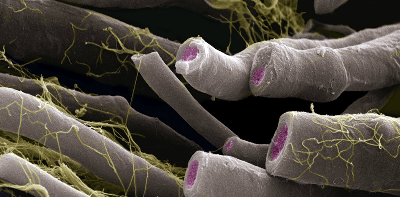 Out-of-balance bacteria is linked to multiple sclerosis − the ratio can predict severity of disease - The Conversation