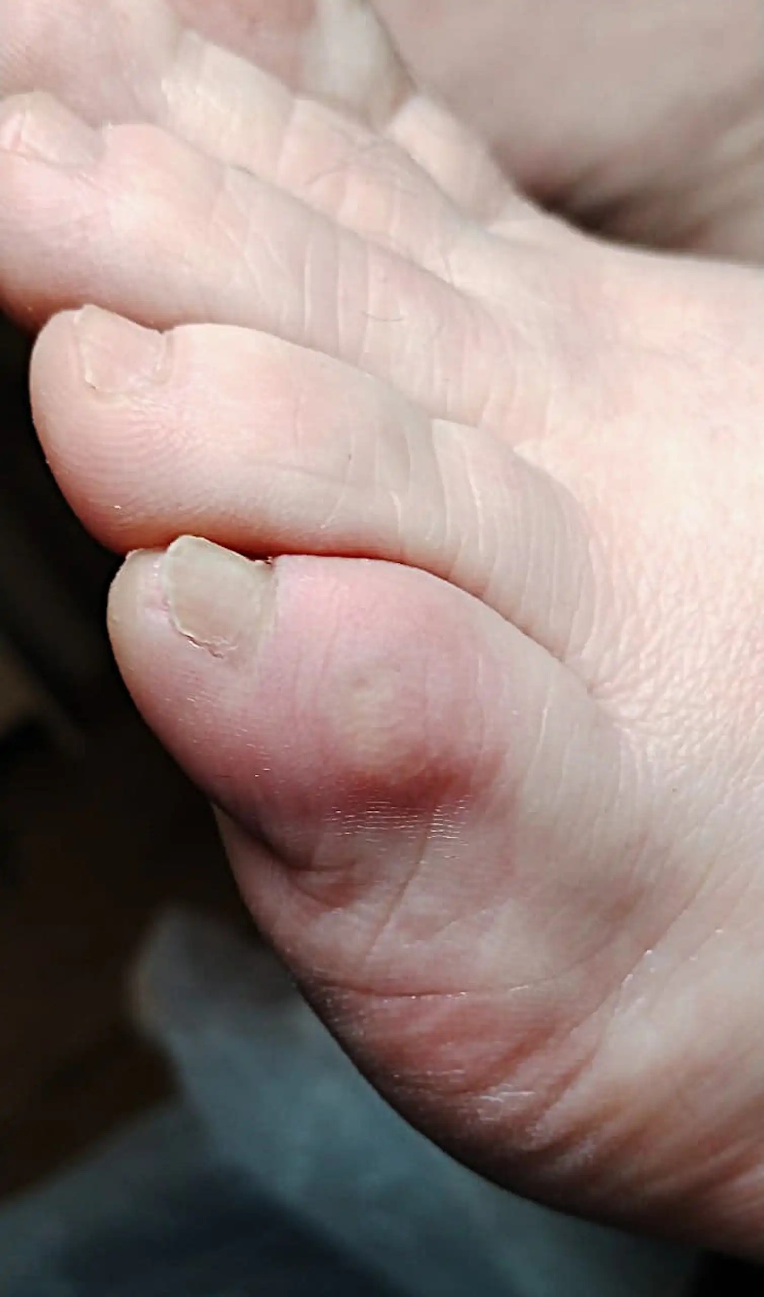 Back Toes Why you should check for ‘Irish pinky toe’ – and what to do if you have one