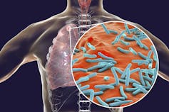 Computer illustration of the microbes that cause TB.
