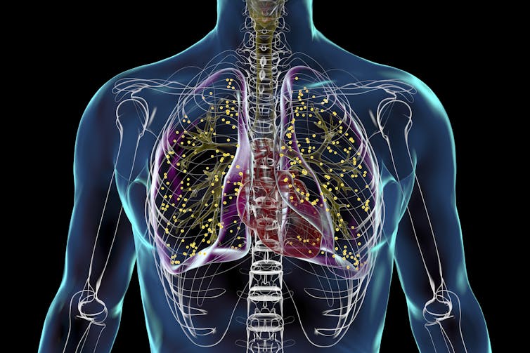 This illustration shows a TB infection in the lungs of a patient.