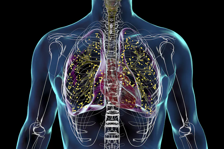 This illustration shows a TB infection in the lungs of a patient.
