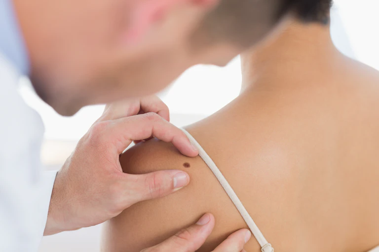 Un médecin examine un grain de beauté au niveau du dos d'une femme
