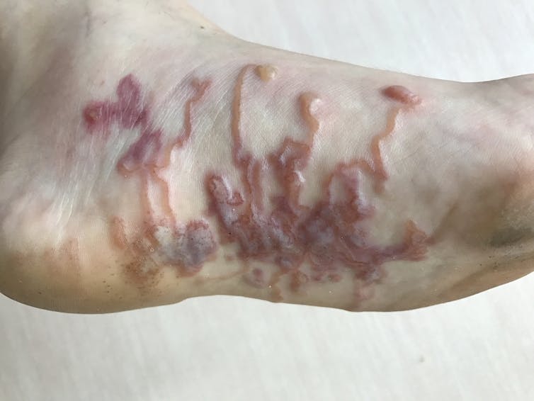 A foot in which a snake -like katinis larvae is shown