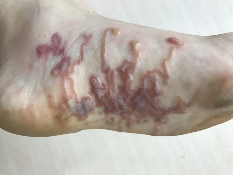 A foot showing the snake-like cutaneous larva migrans