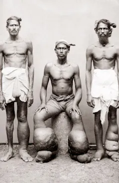 A photo from 1890 of three men with elephantiasis.