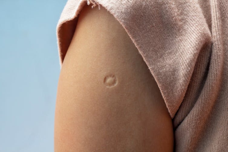 A person with a BCG scar on their upper arm.