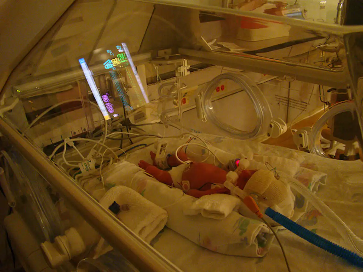 Balancing Hope And Fear For Babies Born At 24 Weeks Gestation Balancing hope and fear for babies born at 24 weeks gestation