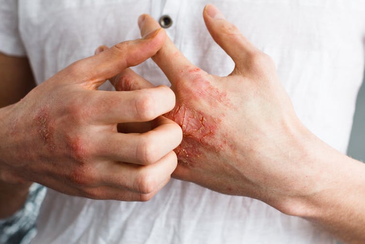 A person's hands with eczema.