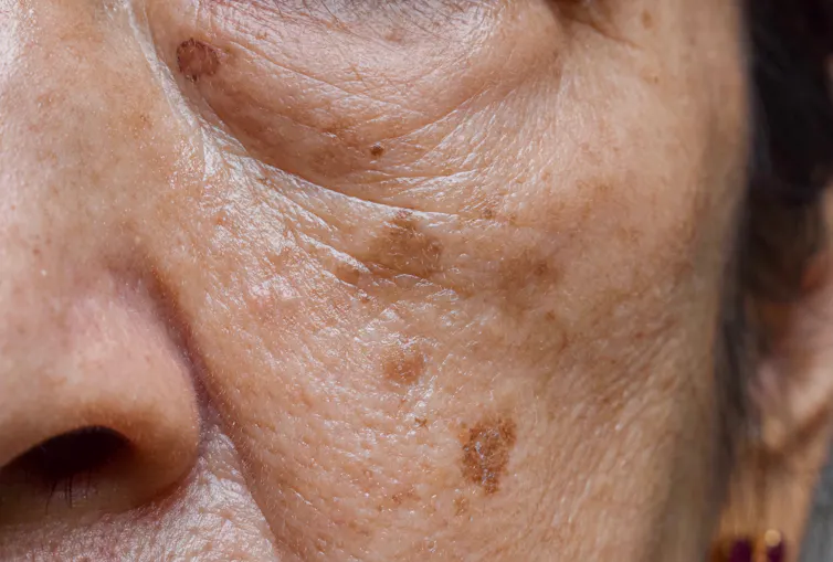 melanotan moles freckles Abnormal seen developing in patients chasing perfect suntan by using peptide melanotan-II What's the difference between freckles,