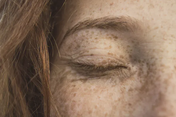 Pecas sobre la cara de una mujer