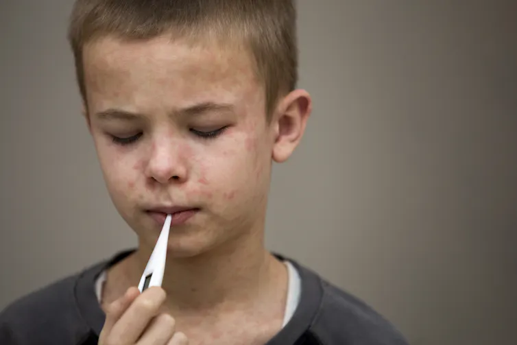 A young boy with measles holds a thermometer in his mouth