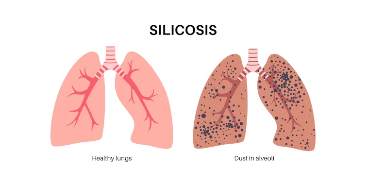 A diagram of a healthy pair of lungs, alongside a pair of lungs affected by silicosis.