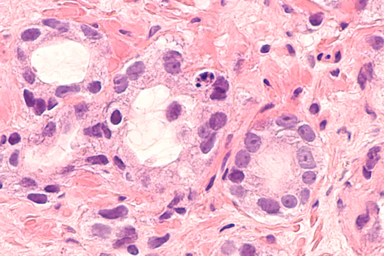 Photomicrograph (microscopic image) of core biopsy of prostate gland showing histology of adenocarcinoma in patient with elevated PSA