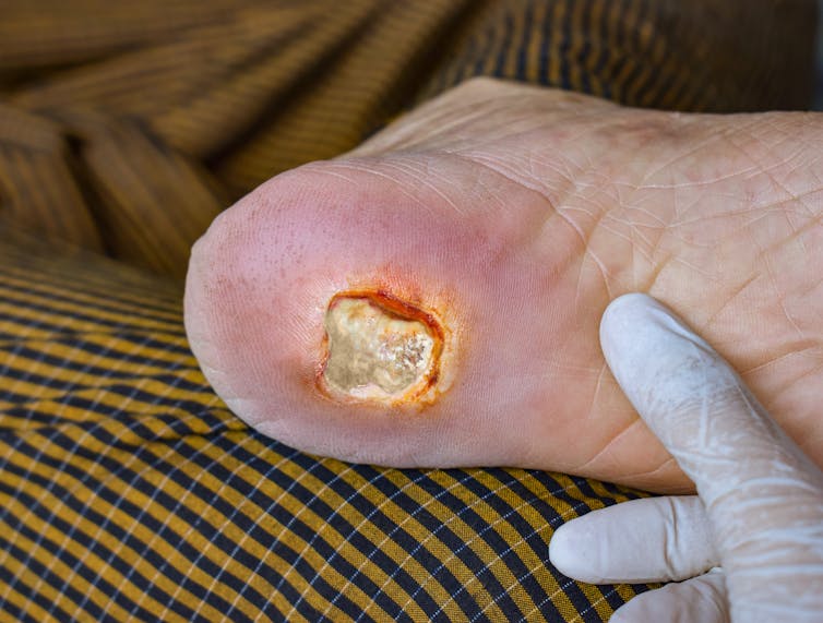 A diabetic foot ulcer.