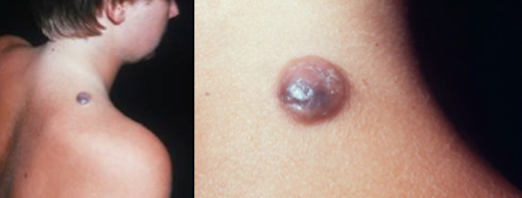 Spot the difference: harmless mole or potential skin cancer?