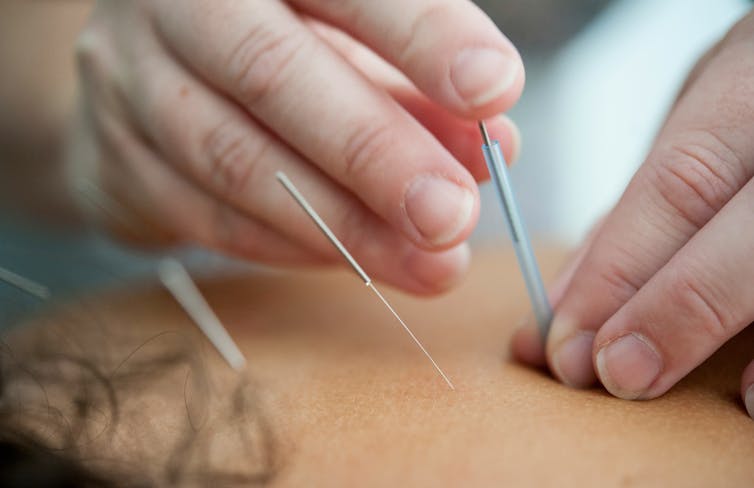 Person gets acupuncture