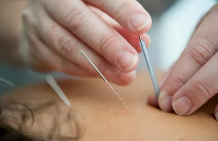 Person gets acupuncture