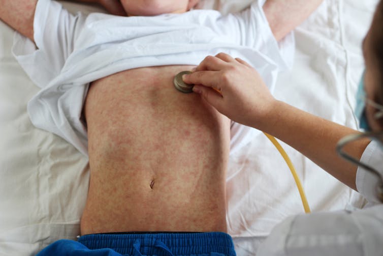 A child's exposed stomach with a measles rash.