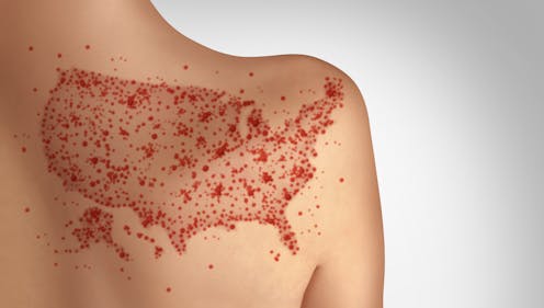 Measles can ravage the immune system and brain, causing long-term damage – a virologist explains