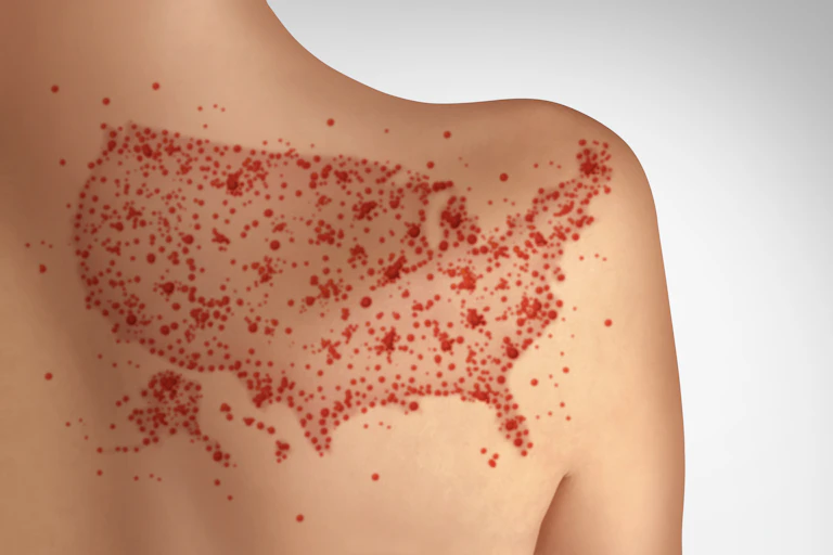 A white child's shoulder with a map made of dots from a measles rash