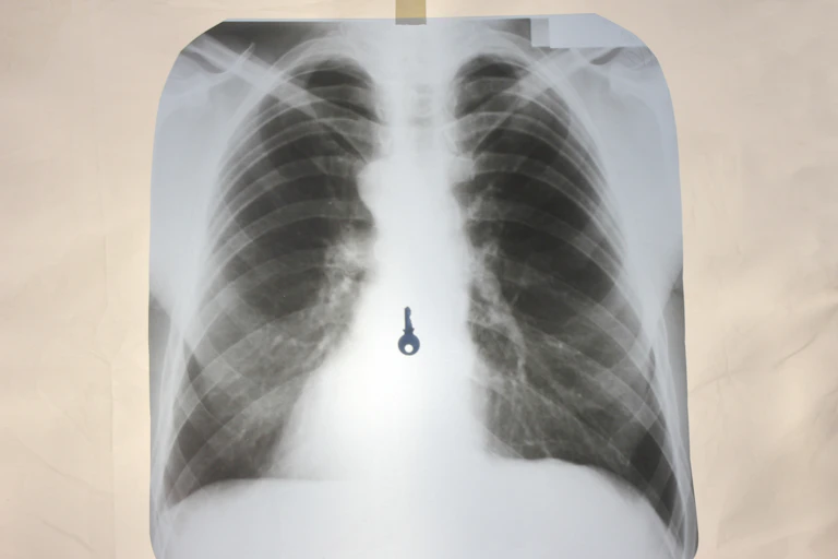 An x-ray of a person's abdomen, showing a key stuck in their stomach.