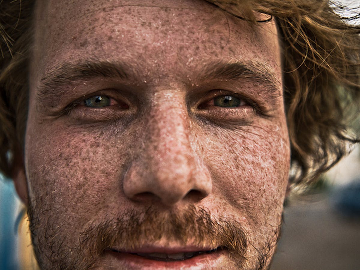 Spot The Difference Harmless Mole Or Potential Skin Cancer Spot The Difference Harmless Mole Or Potential Skin Cancer