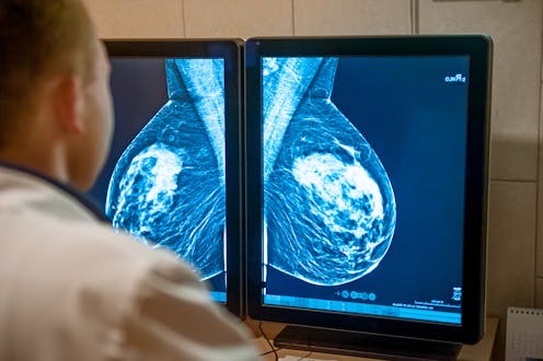 Australian women are wary of AI being used in breast cancer screening – new research