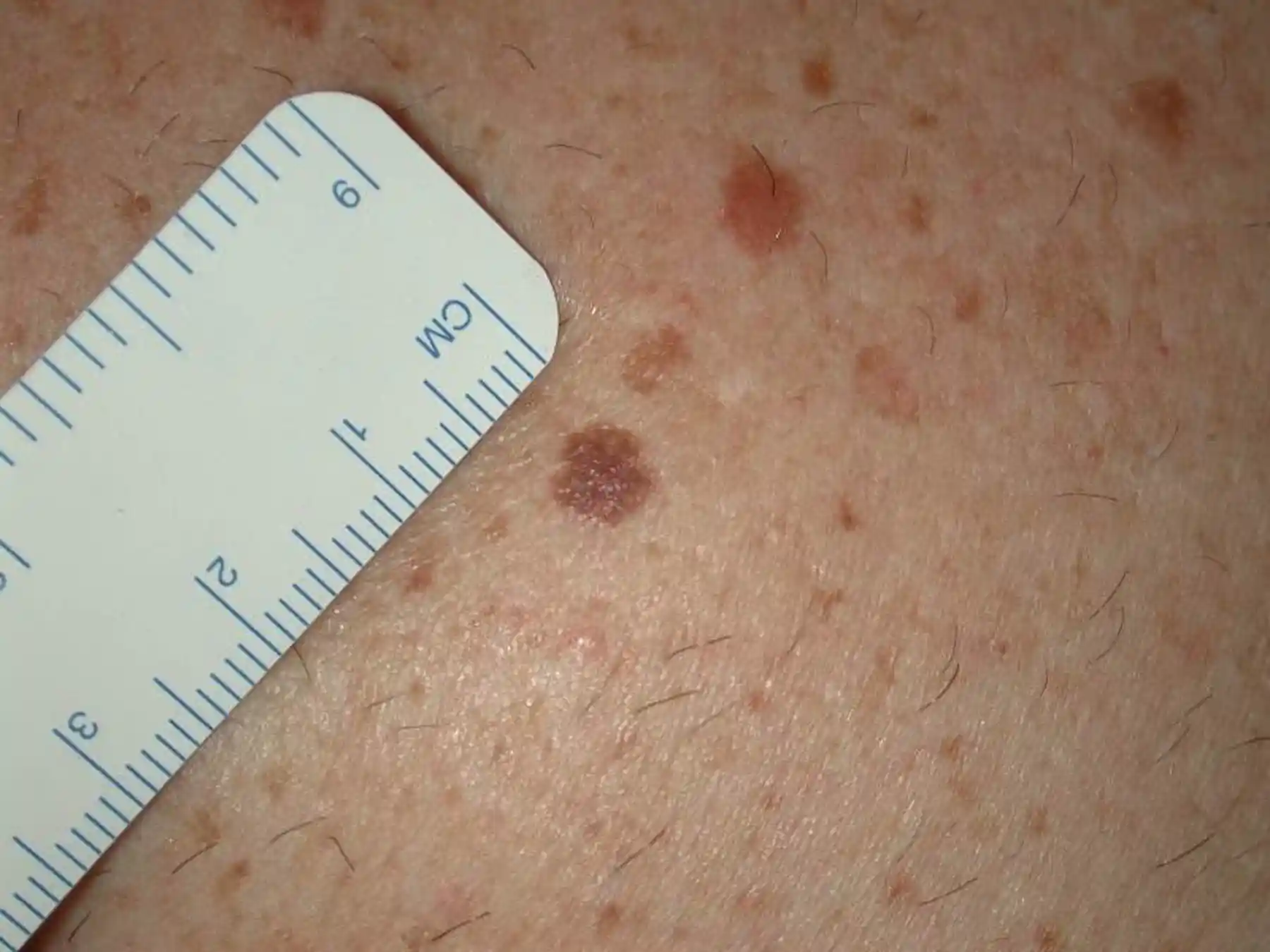 Square Mole Spot the difference: harmless mole or potential skin cancer?