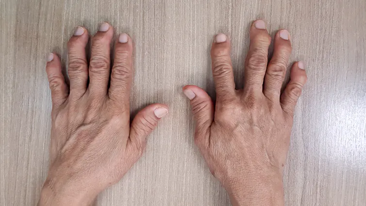 Pair of hands laying flat with bent joints in the fingers.