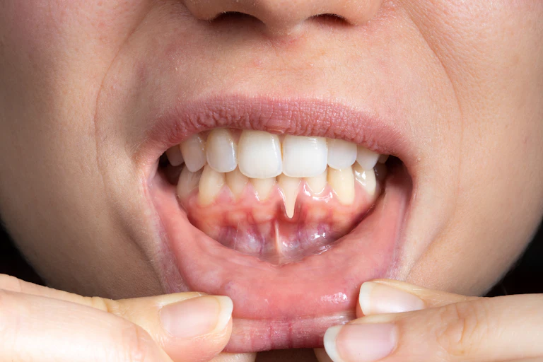 Close-up of a woman's teeth with inflamed red gum and evident gum retraction.