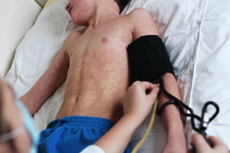 A boy with a measles rash is examined on a bed.